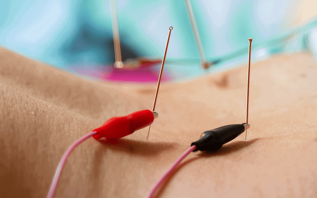 Είδη Βελονισμού. Η γιατρός λειτουργικής ιατρικής Ερυθροπούλου Σοφία εφαρμόζει ιατρικό ηλεκτροβελονισμό σε ασθενή