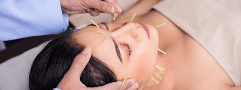 Συνεδρία βελονισμού για πονοκέφαλο και αντιμετώπιση ημικρανιών